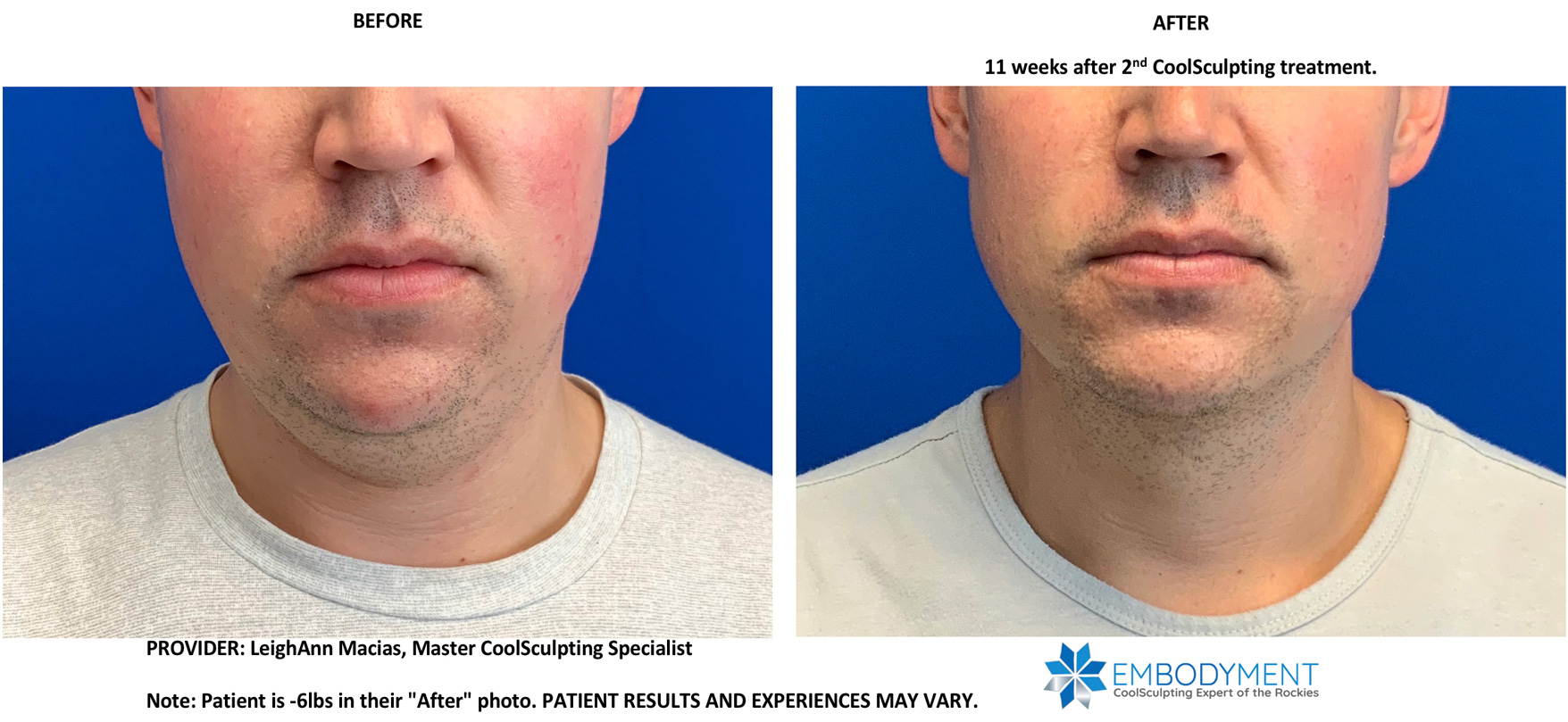 Coolsculpting - MediSkin - Your Look. Our Expertise.