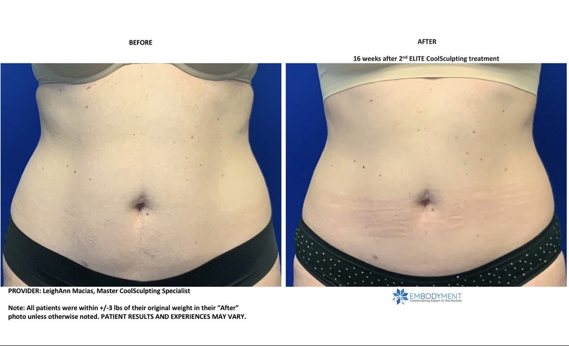 coolsculpting abs