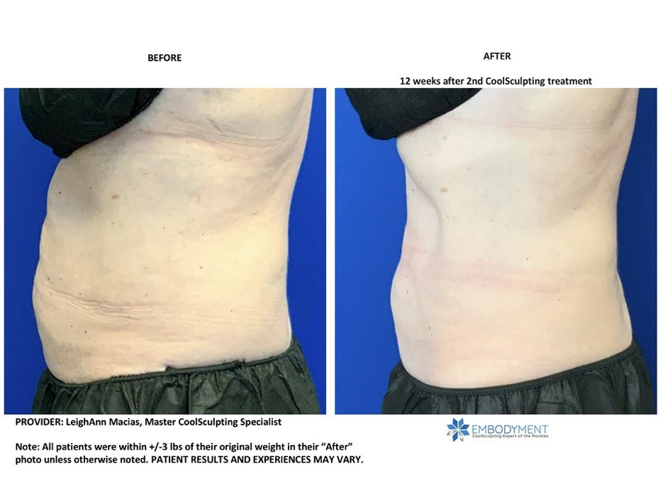 coolsculpting abs