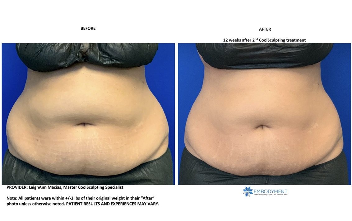 coolsculpting abs