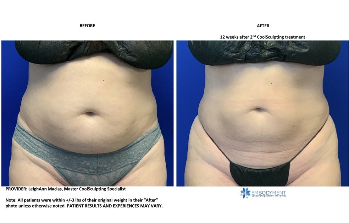 coolsculpting abs