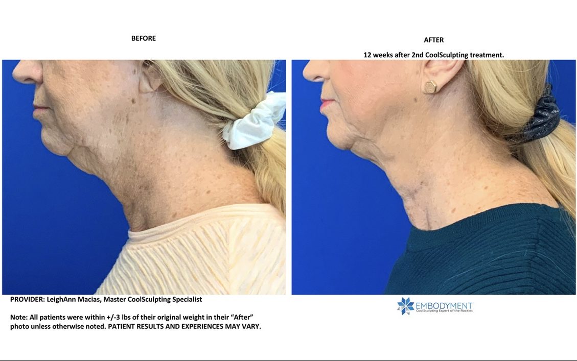 Coolsculpting Chin