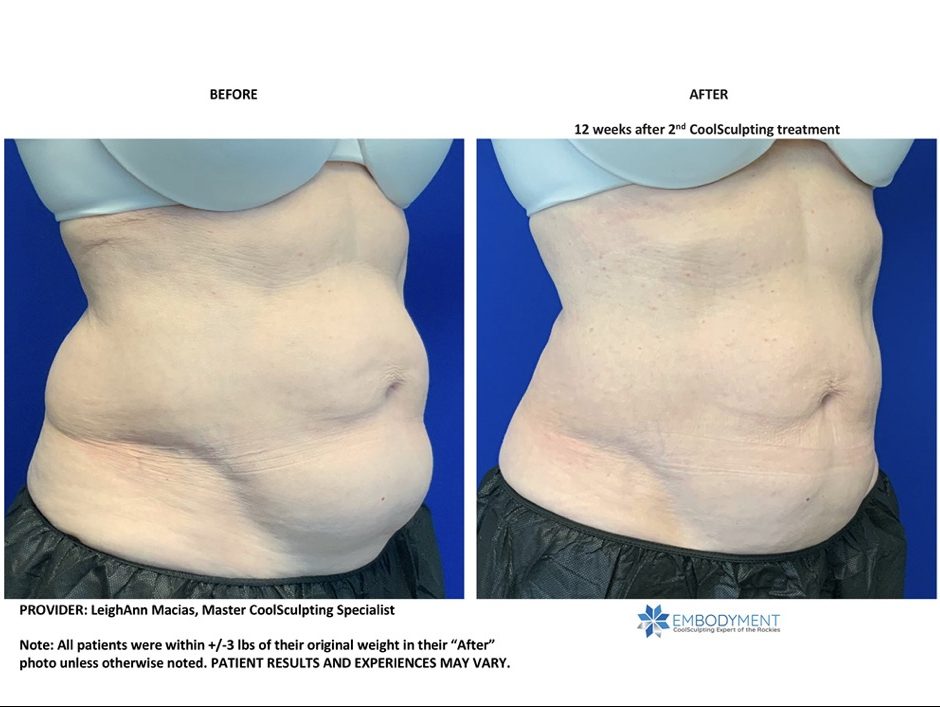 coolsculpting abs