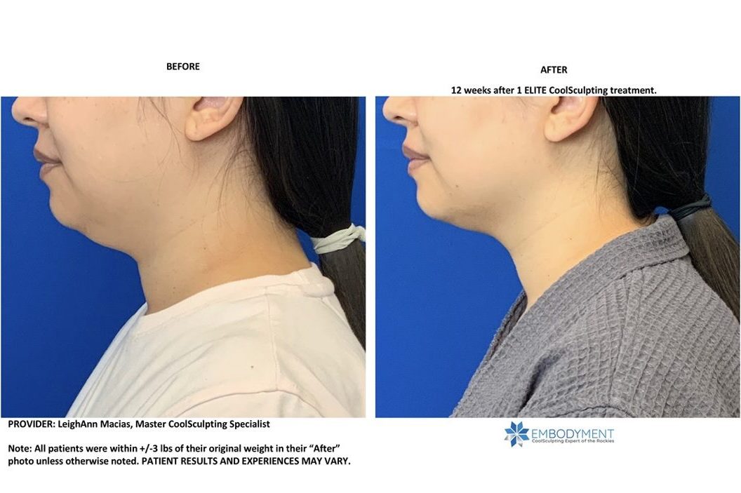 Coolsculpting Chin Results